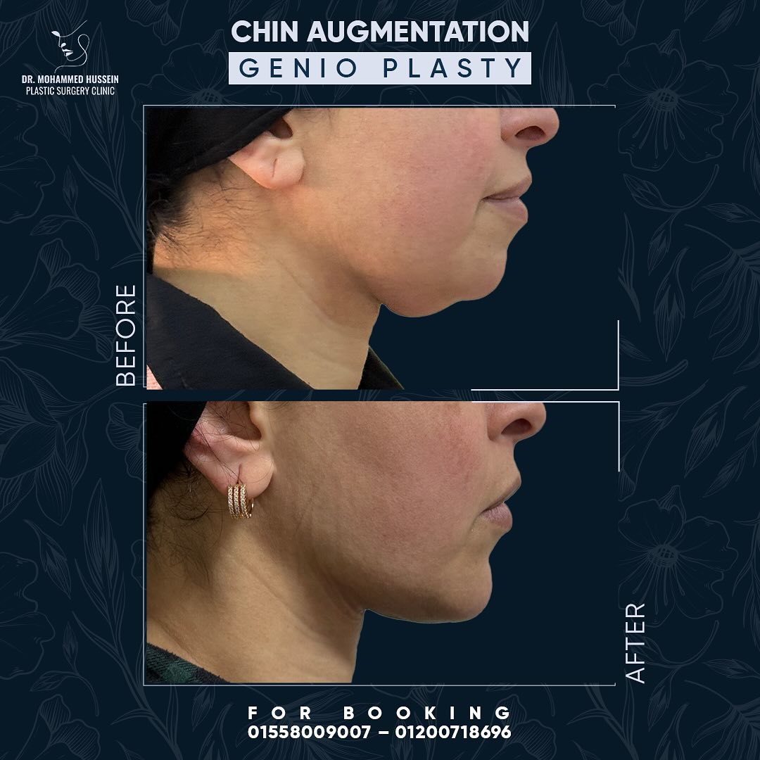 CHIN AUGMENTATION _ GENIO PLASTY _