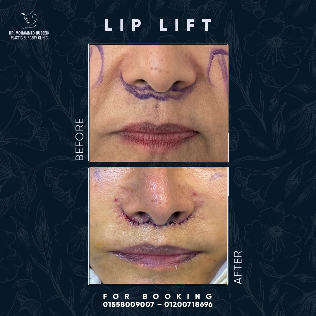 LIP LIFT
