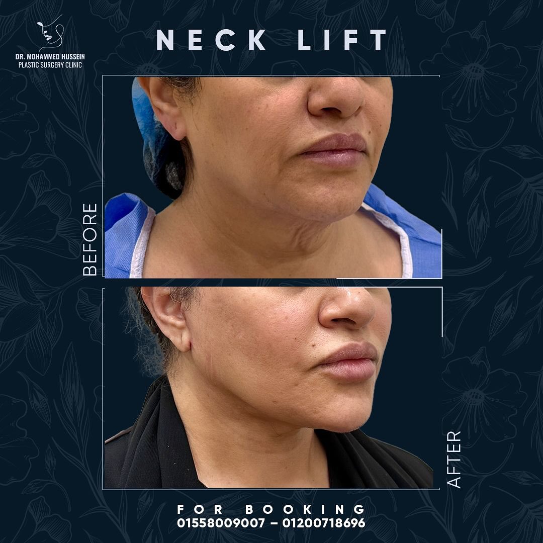 NECK LIFT