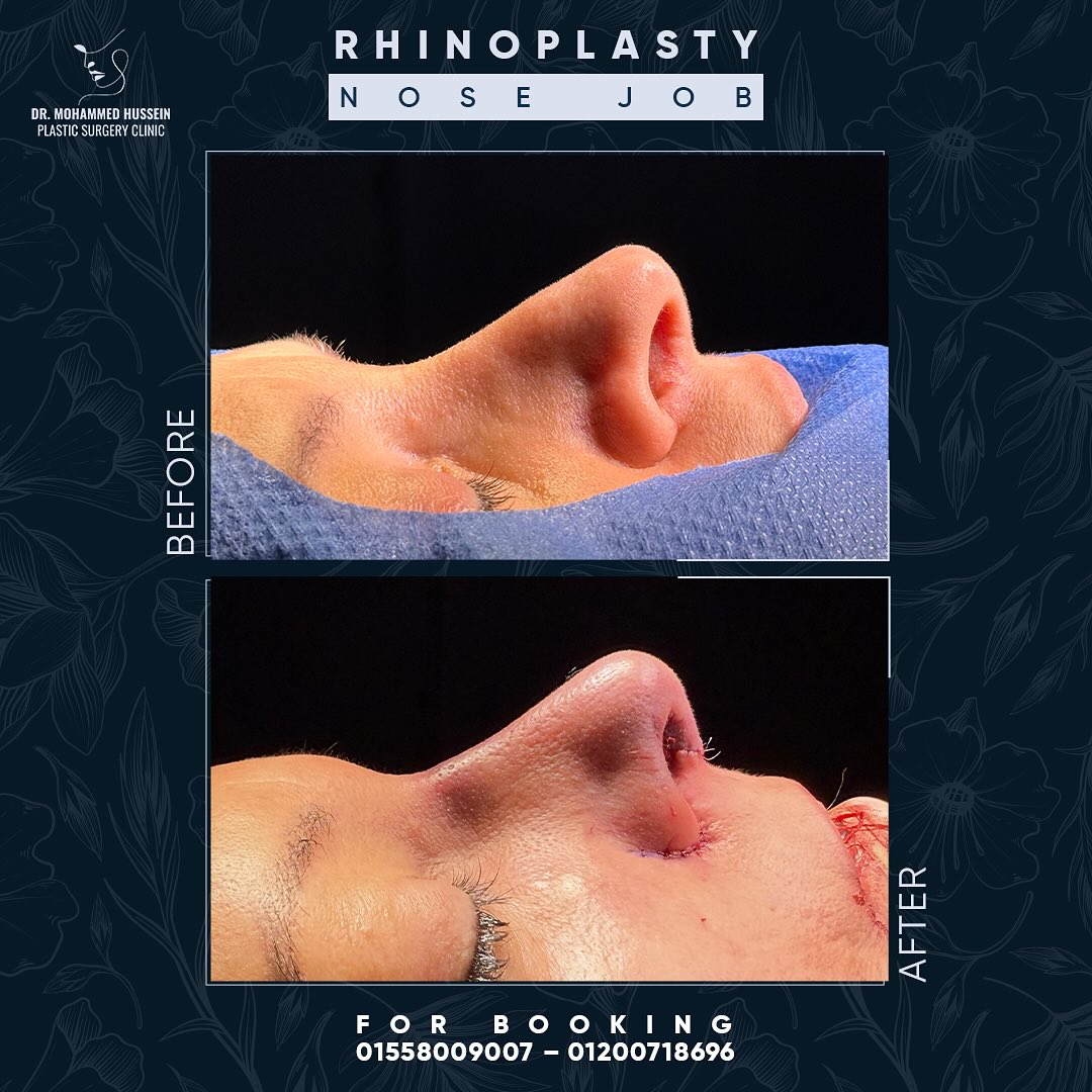RHINOPLASTY _ NOSE JOB _
