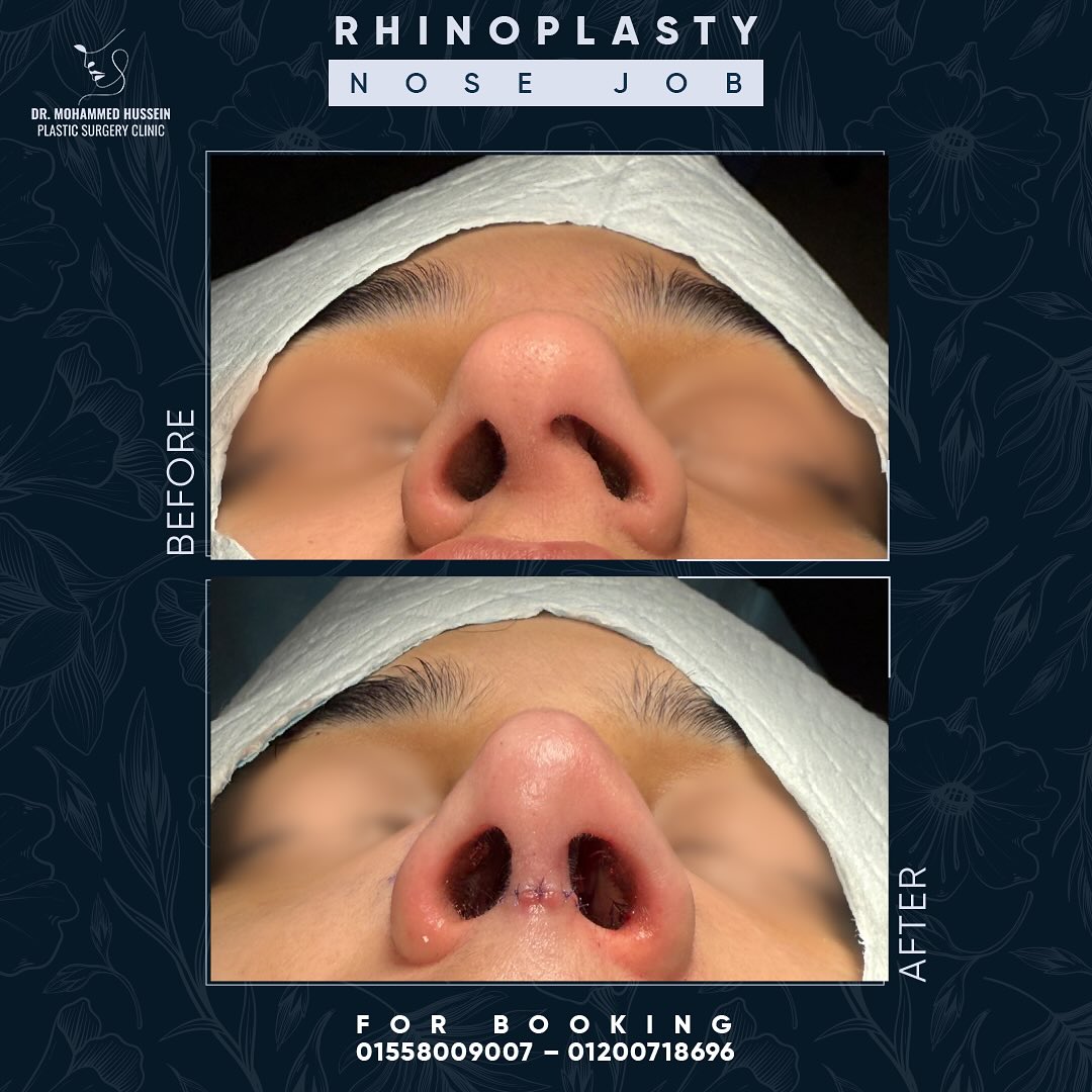 RHINOPLASTY _ NOSE JOB