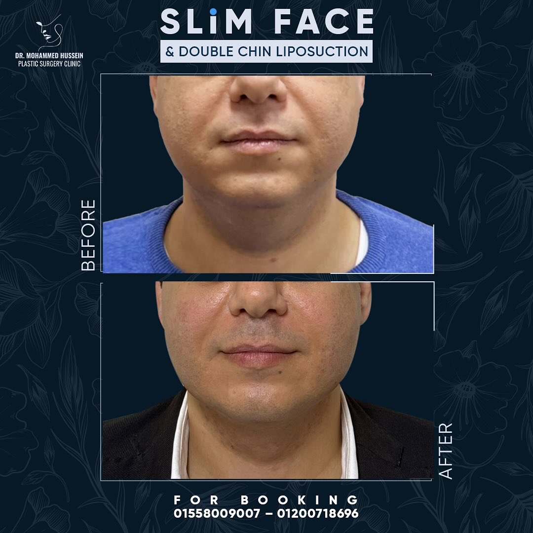 SLIM FACE & DOUBLE CHIN LIPOSUCTION