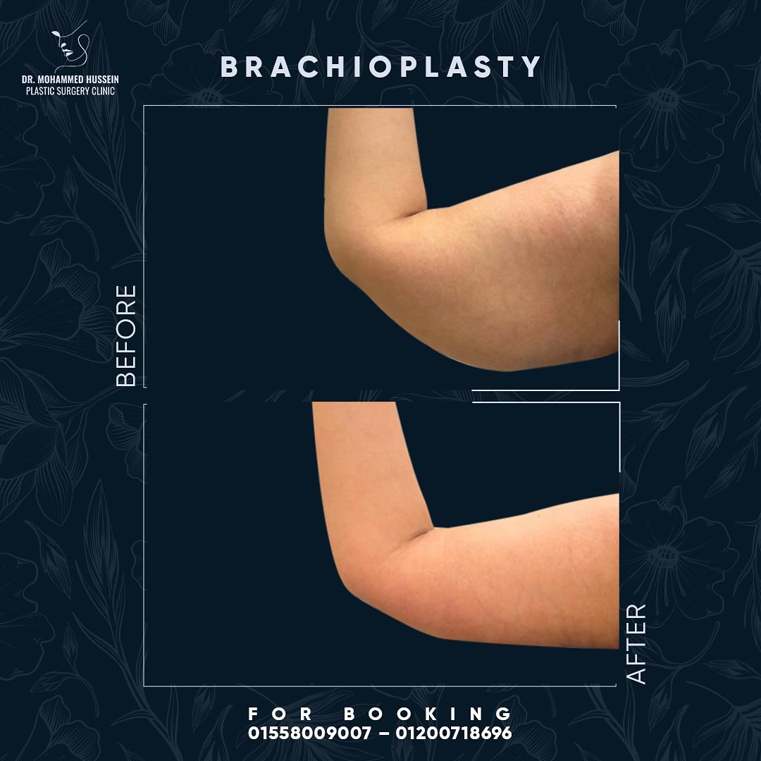 تحول مذهل قبل وبعد شد زراعاتمع د. محمد حسين، حيث نحقق لكِ النتائج التي تحلمين بها بأحدث التقنيات