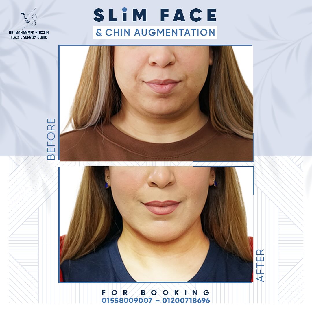 تغيير كبير في شكل الوجه والذقن بعد إجراء تقديم عظمي للذقن، شفط للغد وتنحيف للوجه مع د. محمد حسين(1)