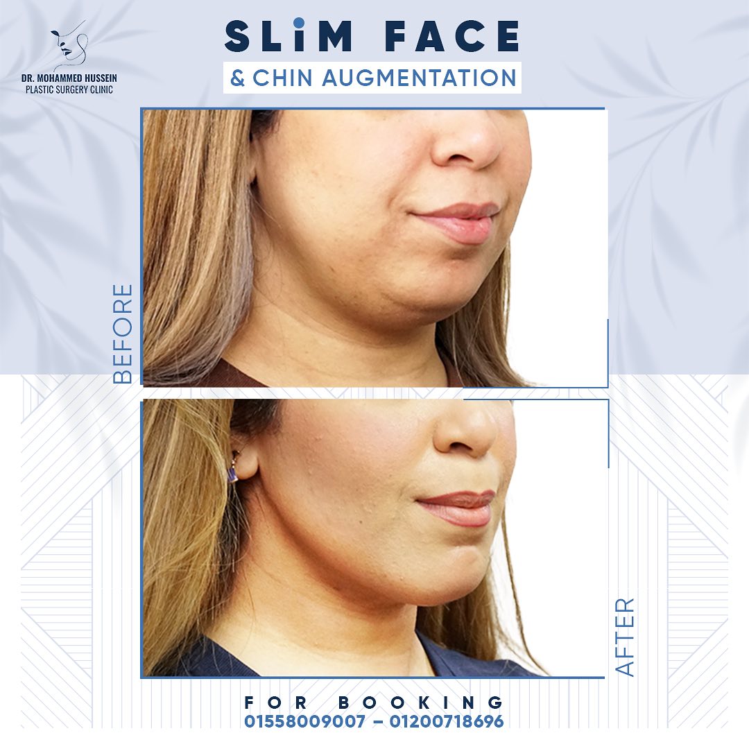 تغيير كبير في شكل الوجه والذقن بعد إجراء تقديم عظمي للذقن، شفط للغد وتنحيف للوجه مع د. محمد حسين(2)