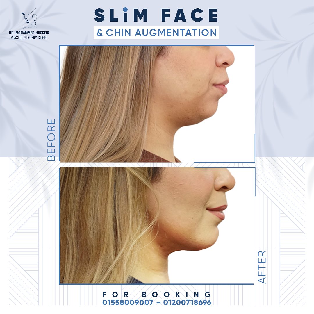 تغيير كبير في شكل الوجه والذقن بعد إجراء تقديم عظمي للذقن، شفط للغد وتنحيف للوجه مع د. محمد حسين(3)