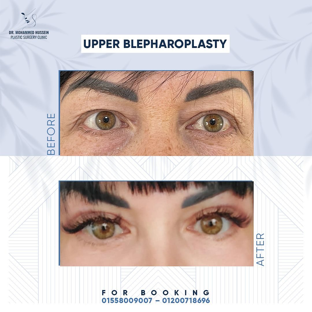 حاله قبل و بعد عمليه تحسين شكل الجفون تقوم العمليه بشد الجفون عن طريق ازاله الدهون الزائده في ا