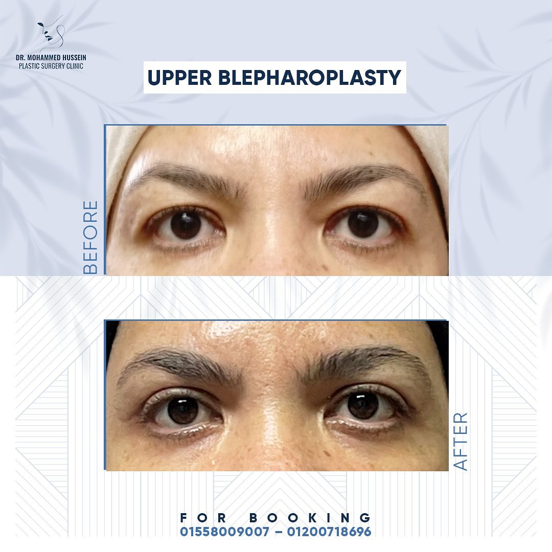 _رجعنا نظرة الشباب من تاني ووصلنا لملامح أصغر بسنين بعد تجميل الجفون العلوية مع د. محمد حسين.The