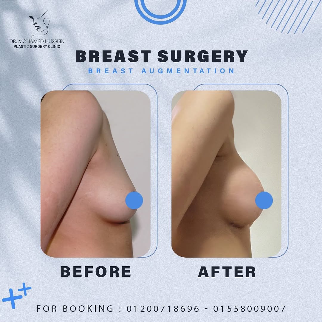 عملية تكبير الثدي بحشوات السيلكون العالمية والأمنة تماما 💯 👌وبدون أي أثار جانبية وبنتيجة مضمون