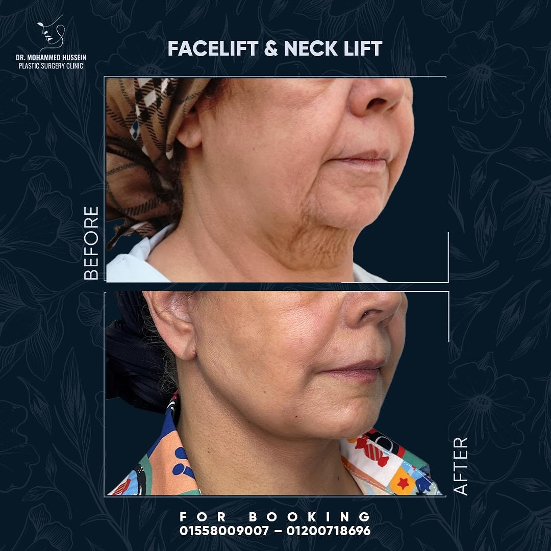 فرق واضح قبل وبعد! ✨ شد الوجه والرقبة لملامح أصغر وأحسن مع دكتور محمد حسين ❤️✨احجزي استشارتك الآ