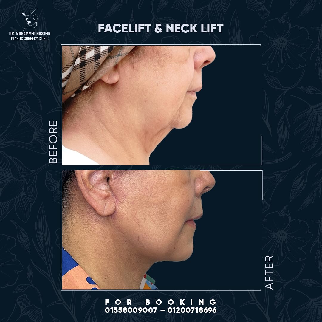 فرق واضح قبل وبعد! ✨ شد الوجه والرقبة لملامح أصغر وأحسن مع دكتور محمد حسين ❤️✨احجزي استشارتك الآ(1)