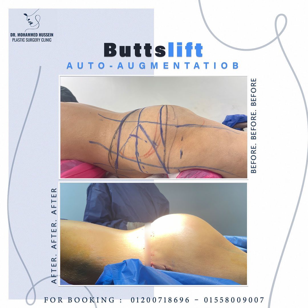 قبل وبعد شد ترهلات المؤخره مع تكبير للمؤخره بالانسجه الذاتيه ✨🤩Before & After Butts Lift Auto-