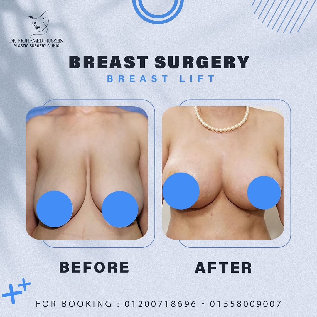 لو عندك ترهل في الصدر بسبب الرضاعة او نقص الوزن الكبير متقلقيش.. لأن شد الترهلات ورفع الصدر دلوق