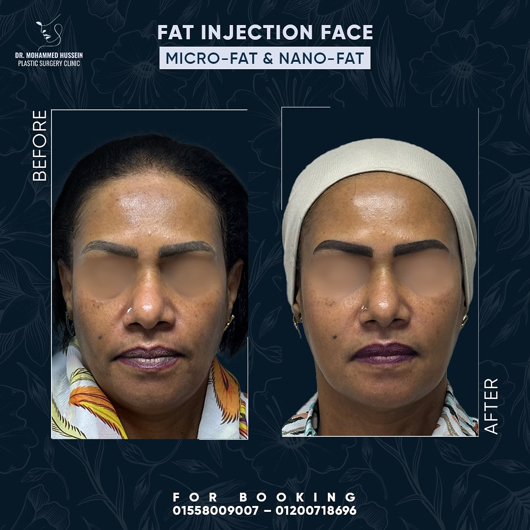 نتائج مذهلة حقن الدهون في الوجه مع أ.د محمد حسين هتستمتعي بجمال طبيعي يستمر مدى الحياة وملوش فتر