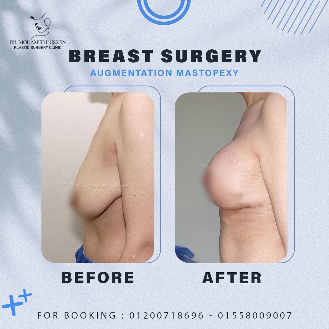 نجاح كبير ونتيجة أكتر من ممتازة بعملية تكبير و رفع الثدي اللي تمت على إيد أ.د محمد حسين.عمليات ت