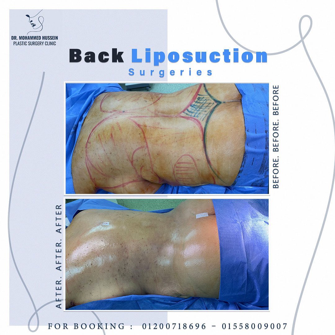نحت الضهر والمؤخره مع شفط وتوزيع الدهون لاعطاء جسم متناسق وكيرفي جذاب مع استاذ دكتور محمد حسين .
